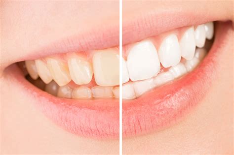 clear teeth   treatments