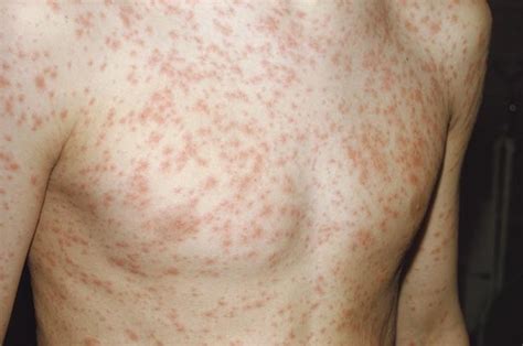 measles rash pictures symptoms causes treatment home