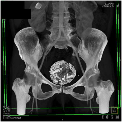 How To Get To Section X Calcified Ct Uterine Fibroids Ctisus