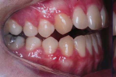 mordida aberta anterior por extrusão dos dentes posteriores cesar bigarella