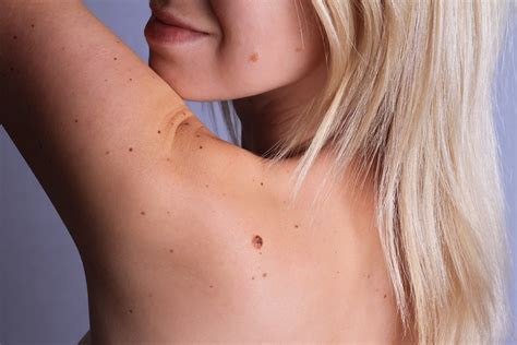 Skin Cancer And Melanoma What To Look Out For Abcde