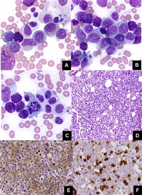 myelomastocytic leukemia with aberrant cd25 expression case report and