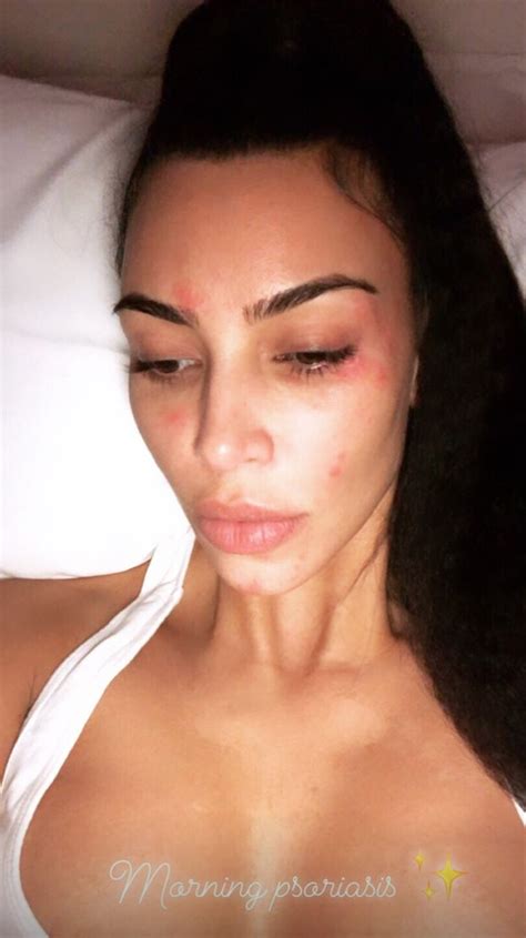 kim kardashian shows face covered in psoriasis ahead of sunday service