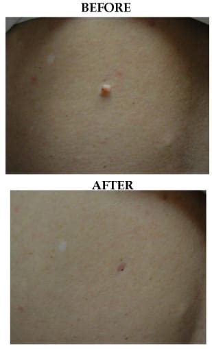 Before And After Skin Tag And Mole Removal Patient 02 The Medical Spa