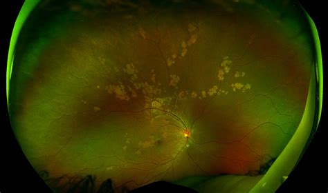 ophthalmology dx tracking    white retinal spots