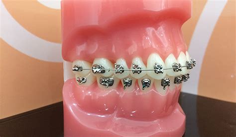How Do Braces Work On Your Teeth [comprehensive Guide]