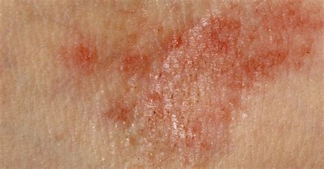 Side Effects Of Vitamin B Hives Rash And Heat Livestrong