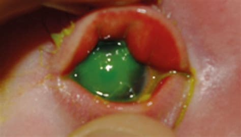 herpes simplex ophthalmia neonatorum a sight threatening diagnosis