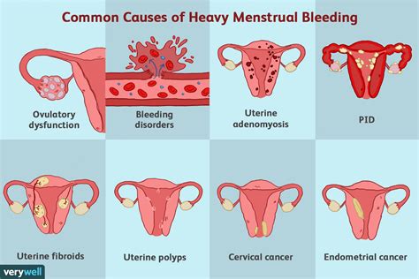 Heavy Menstrual Bleeding Menorrhagia Symptoms And More