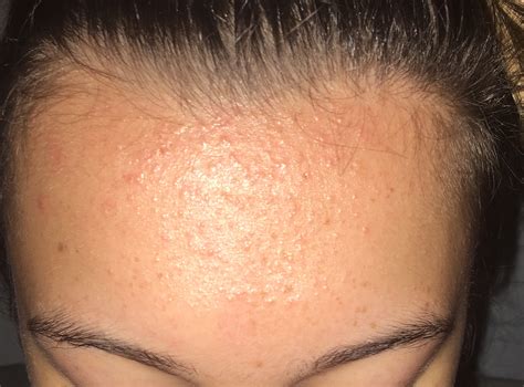 forehead bumps acne  works general acne discussion acneorg