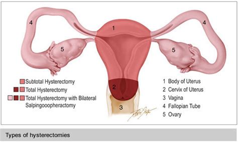 recovery after a hysterectomy how long and what to expect