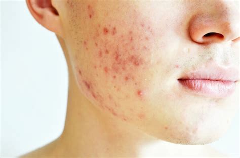 Complexion Issues Acne Issues Acne Treatments Acne Products