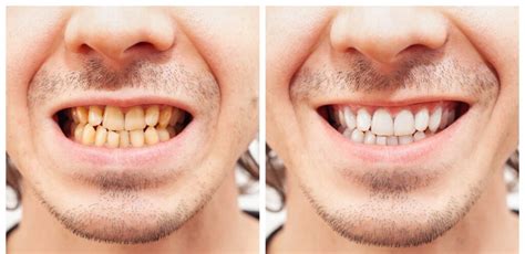 tanden bleken deventer de  tandartspraktijk  nederland