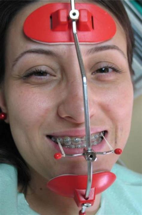 headgear braces adults use braces