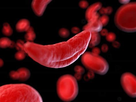 sickle cell anemia site title