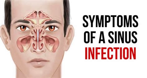 details   symptoms   treatment  sinus infection scoopify