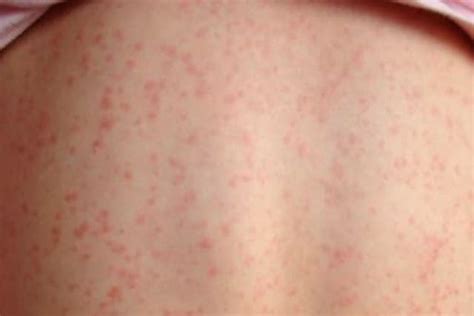 Red Spots On Skin Patches Small Tiny Pinpoint Not