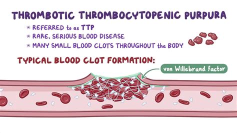 thrombotic thrombocytopenic purpura video anatomy osmosis