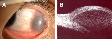 A Conjunctival Cyst With Delayed Internal Hemorrhage After Strabismus
