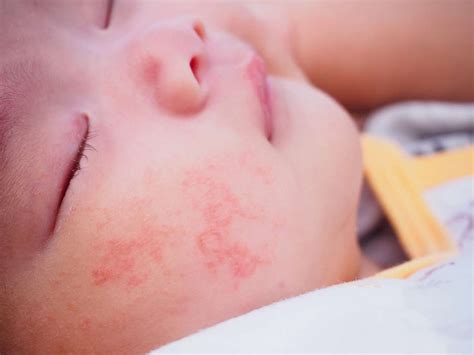 allergic reaction  baby treatment  pictures