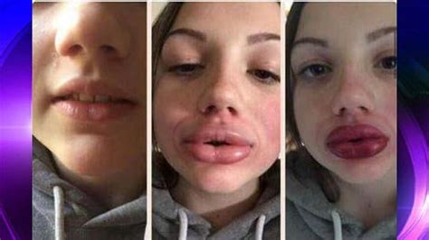 Kylie Jenner Lip Challenge Could Cause Permanent Damage
