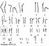 Karyotype Patau Sindrom sketch template