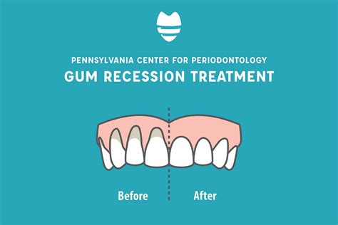 treatment  gum recession periodontist  enola camp hill area