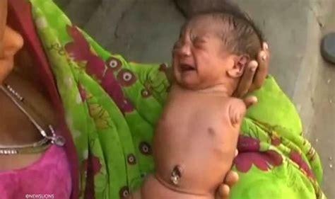 baby born   limbs    birth  india world