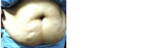 a proposed mesh placement for repair of ventral hernia and contouring
