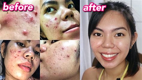 How I Cleared My Acne Cystic Hormonal Acne With Pcos Philippines