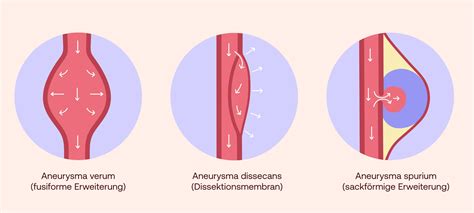 aneurysma symptome ursache shop apotheke