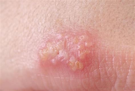 How Effective Is Acyclovir For Herpes With Pictures