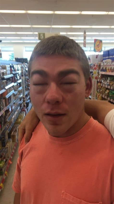Photos Of Severe Allergic Reactions Best Allergy Sites