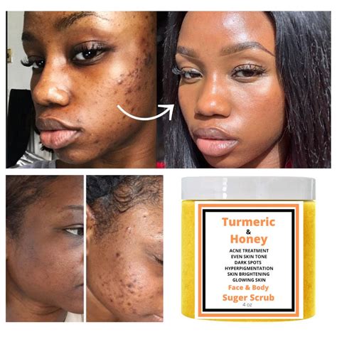 turmeric scrub dark spots acne smooth glowing skin etsy