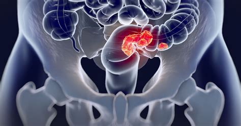 Colorectal Cancer Symptoms Causes Diagnosis And Treatment Options
