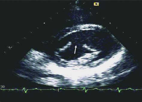 Isolated Cleft Mitral Valve In Adult Thoracic Key