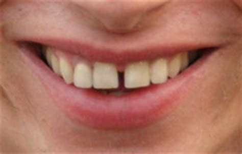 fill  gap   smile dentist san juan capistrano ca cosmetic dental implants