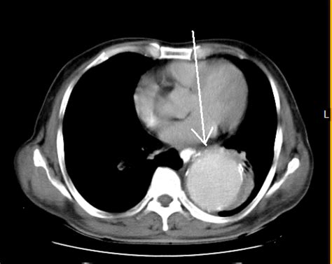 aortic aneurysm ct sumers radiology blog