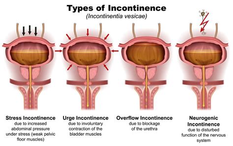 Causes And Types Of Stress Urinary Incontinence – Chicago Urogynecology