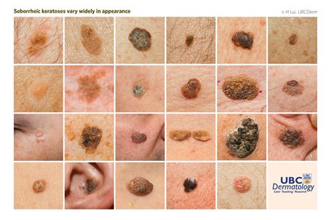 seborrheic keratoses vary widely  appearance  grepmed