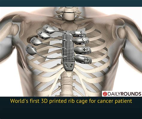 Worlds First 3d Printed Rib Cage For Cancer Patient Dailyrounds