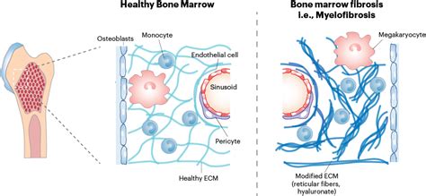 deconstructing  mechanics  bone marrow disease penn today