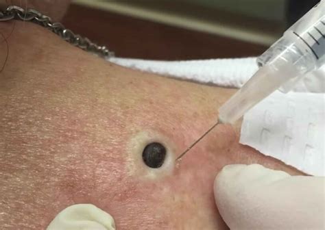 dr pimple popper the best pops on youtube film daily