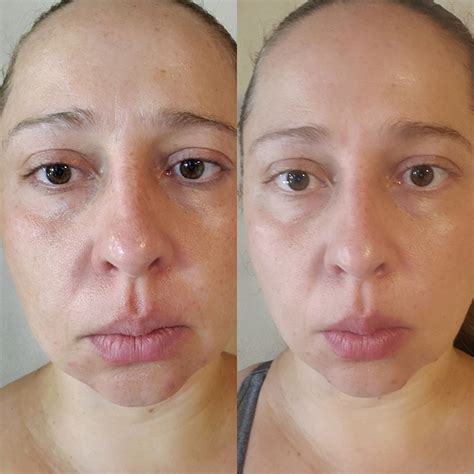 microcurrent facial before after eleven wellness iv