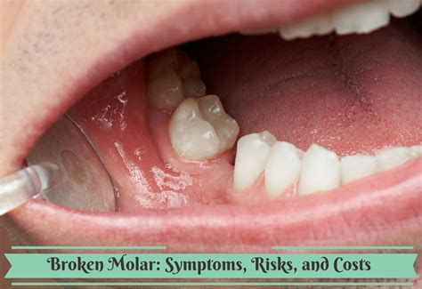 broken molar symptoms risks  costs