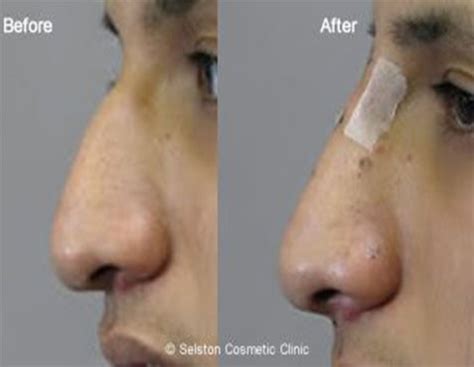 selston cosmetic clinic nose shape correction  surgical nose job nottingham derby