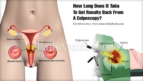 sex after a colposcopy sex after a colposcopy