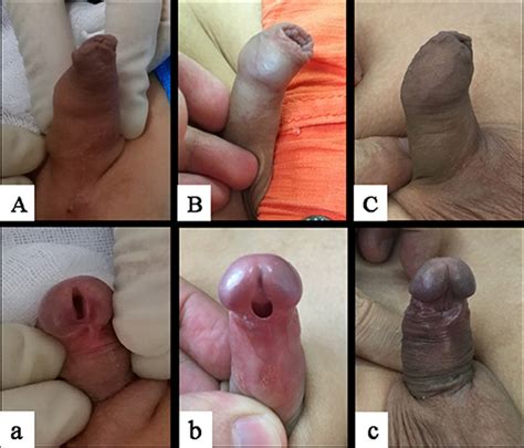 Frontiers Diagnosis And Treatment Of Hypospadias With