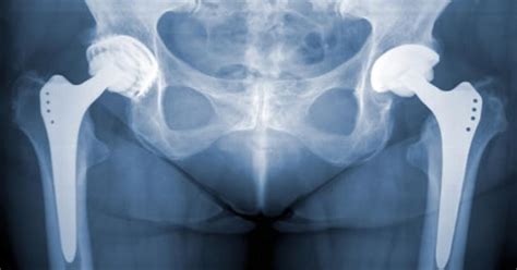 total hip replacement procedure details