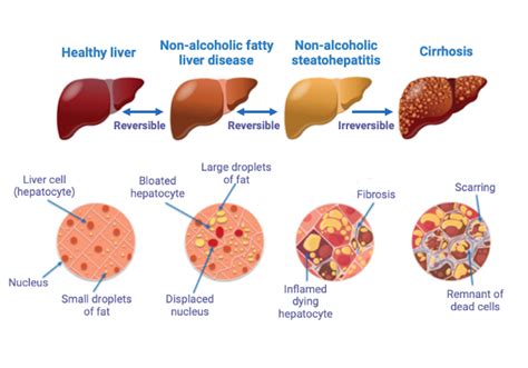 A Growing Health Concern The Causes And Treatments For Fatty Liver
